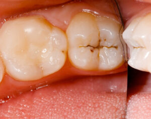 How to Assess Your Risk for Tooth Decay