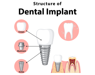 Dental Implants Howell, MI