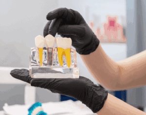 Dental Implant Process