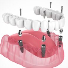 Implant-Supported Dentures