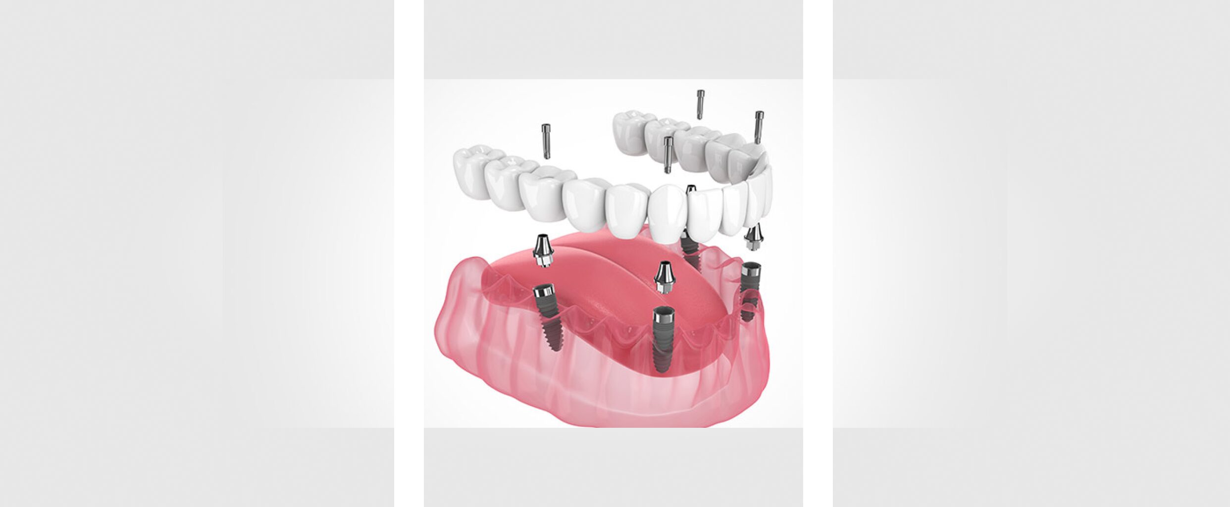 Implant-Supported-Dentures