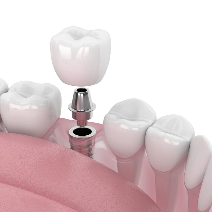 Single-Dental-Implants
