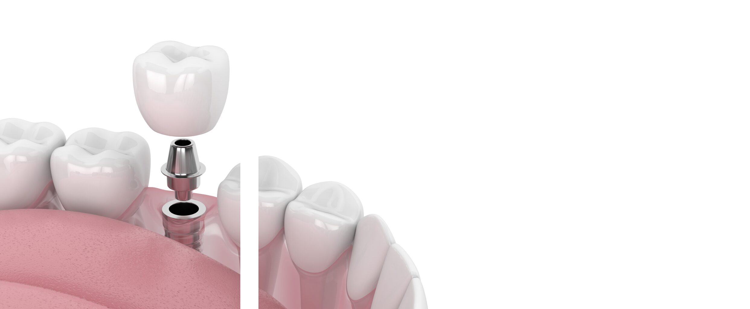 Single-Dental-Implants